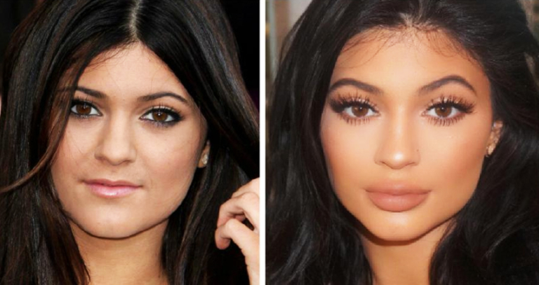 Kylie Jenner a mis le paquet pour ses opérations de chirurgie esthétique